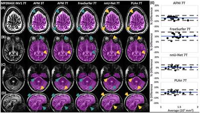 Pseudo-Label Assisted nnU-Net enables automatic segmentation of 7T MRI from a single acquisition